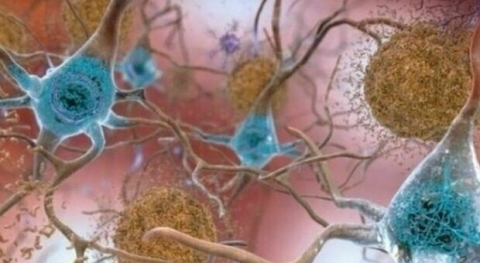 Alzheimer: ad Arezzo un avamposto della ricerca avanzata per l’epidemia sociale del futuro